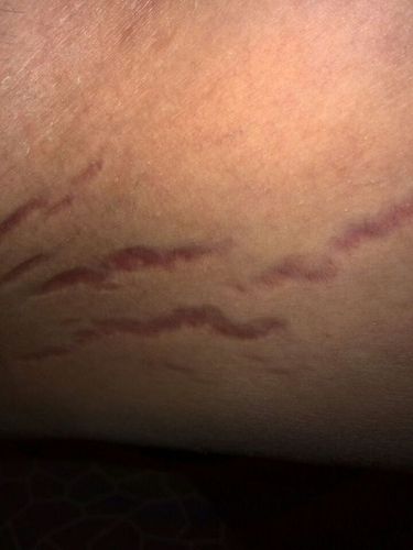 医生这是肥胖纹吗,本人也就70公斤,如果