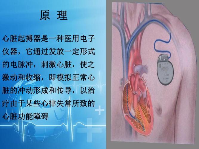 心脏起搏器ppt