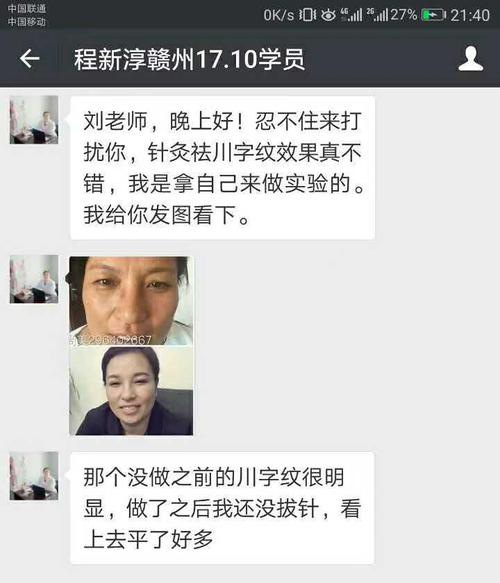 刘吉领——三针治疗鼻炎简单手法