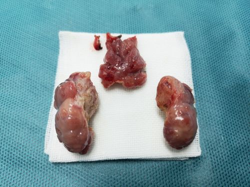 腺样体完整切除后不会复发