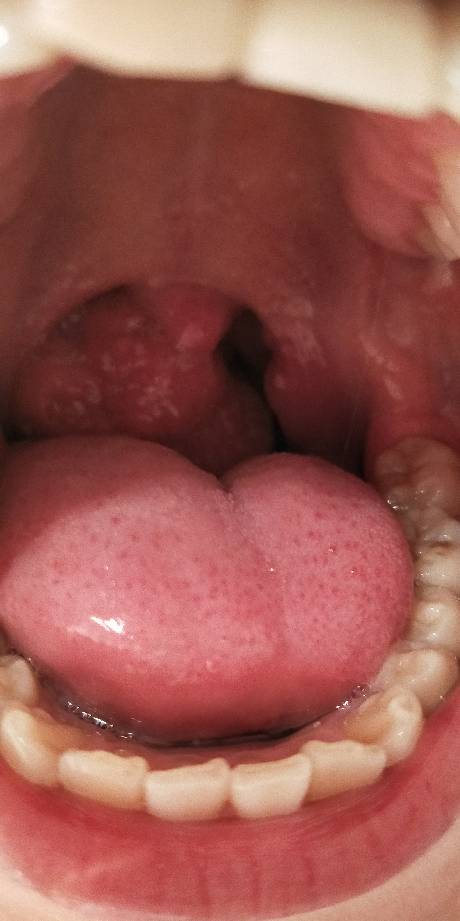 喉咙这是息肉还是什么?