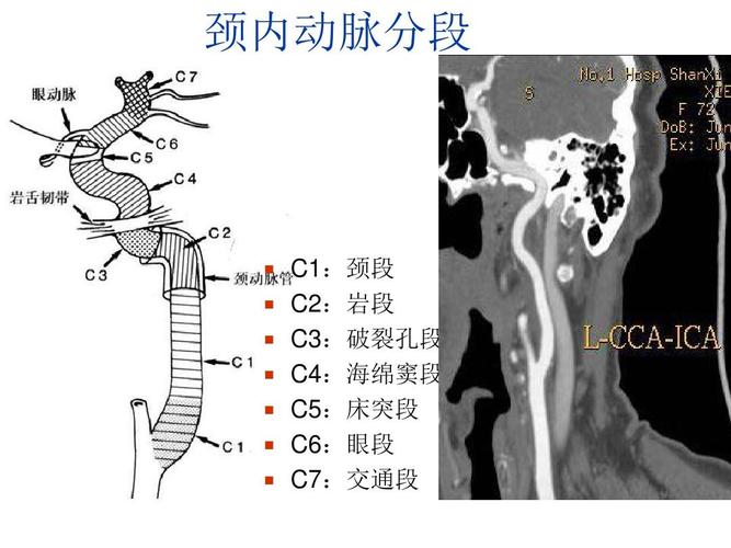 颈内动脉分段   c1:颈段   c2:岩段   c3:破裂孔段   c4:海绵窦段
