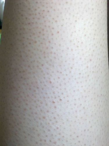 毛周角化症(鸡皮肤)本质上究竟是什么导致的,能改善吗