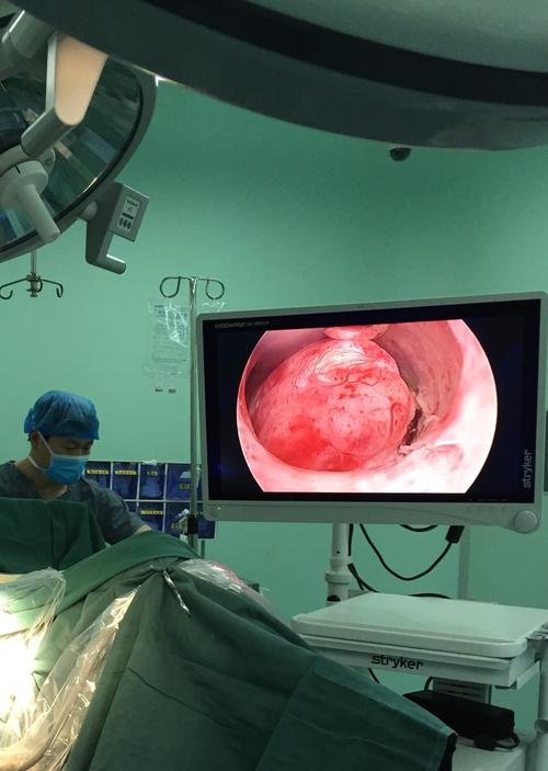 我们为一位子宫内膜息肉的病人在宫腔镜下做息肉切除,看起来有点恐怖