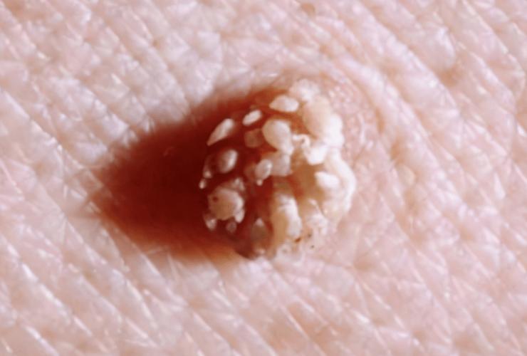 小情侣相继感染hpv,医生:无论男女,只要2处长"疙瘩",要警惕