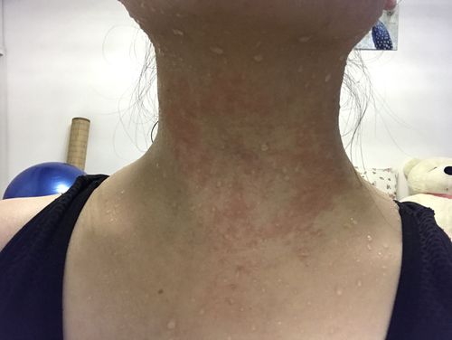 请问脖子上这个是皮炎还是湿疹啊?只有脖子上有,突然起来的,痒痒