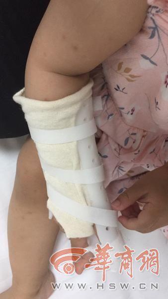 西安一岁幼儿在童乐园蹦床被小男孩推倒三次离开半小时后发现右手骨折