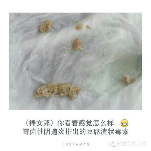 棒女郎【知识篇】各种妇科炎症症状和排出垃圾图片参考