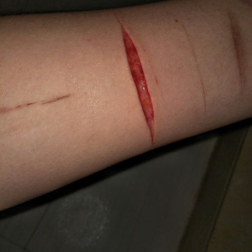 这样的伤口需要缝针吗