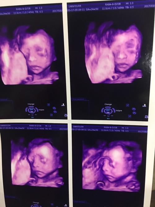 四维彩超,保健品,妊娠纹,怀孕,孕妇