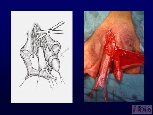 变性手术女变男效果图变性手术女变男3d动画