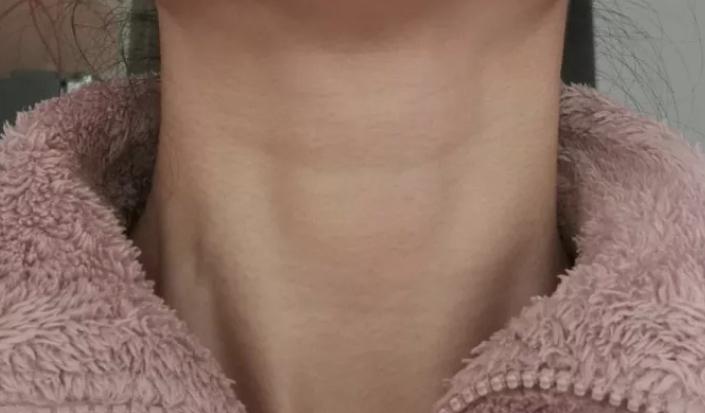 很像喉结 又很像甲状腺肿 按理女生是没有这块 吞咽会上下移动