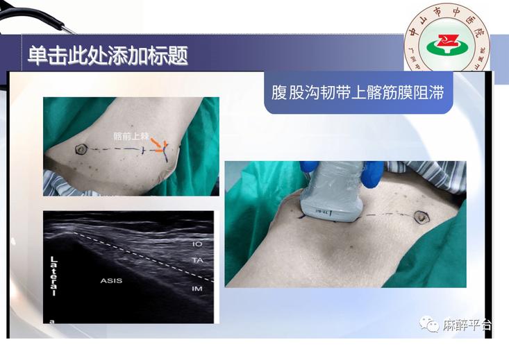 ppt:超声引导高位髂筋膜阻滞在临床中的应用