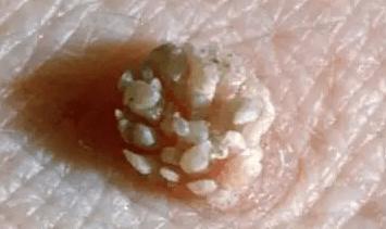 19岁女生感染hpv后长"菜花",为何没有性行为也会得?医生这么说