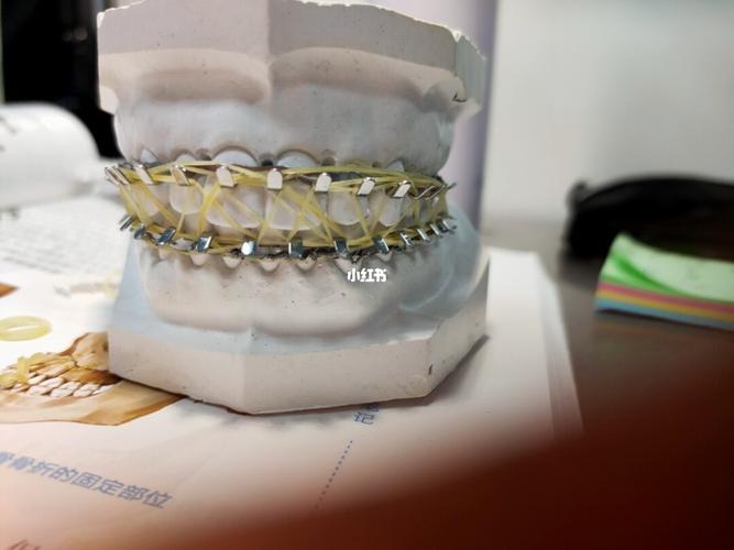 颌骨骨折的固定_夹板_医学生_口腔_医疗健康_医疗健康