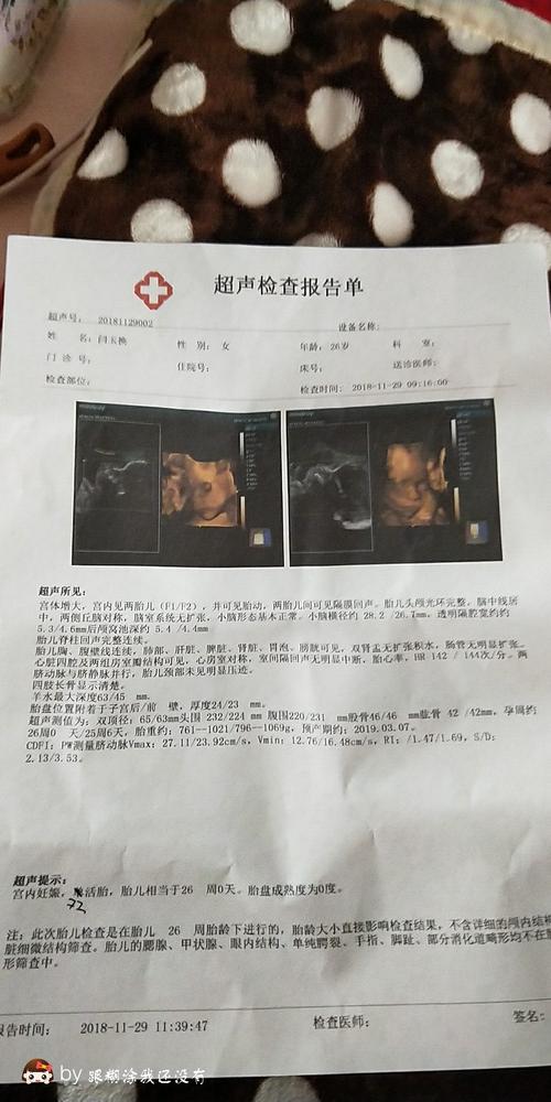 我的双胞胎四维彩超