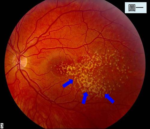 黄斑变性,老年人的视力杀手