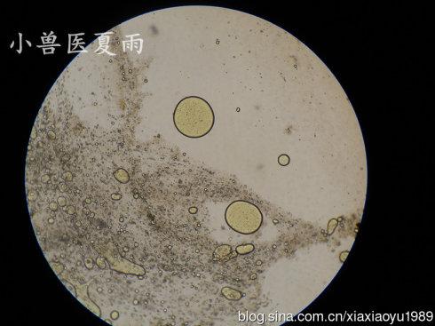 粪检大量脂肪滴(图)