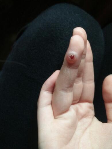 手上长了个血管瘤,做了冷冻治疗一周后,上面好像长了个泡,又好像是肿