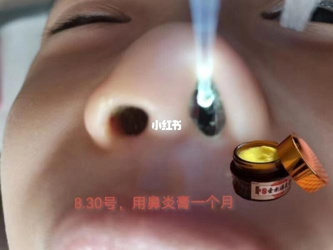 顾客儿子鼻息肉 用一个月鼻炎膏不见了 现在继续用了一个月修复鼻腔