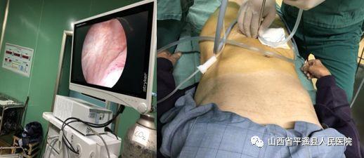 (闫中庆主任在膀胱镜下巧取膀胱结石)