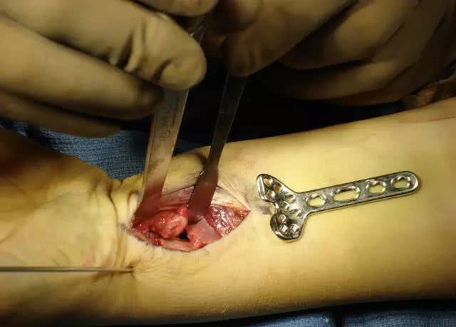 桡骨远端骨折掌侧钢板内固定