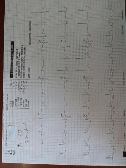 心电图示:急性下壁心肌梗死,查心肌酶谱明显高于正常.