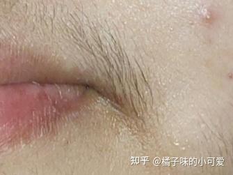 女生嘴边的唇毛多怎么办
