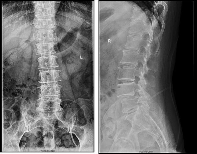 专科检查:腰椎生理弯曲存在,腰椎活动度受限;腰4-5棘突及棘突旁压痛