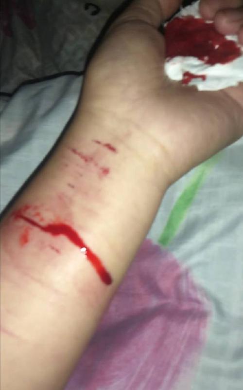前两天用刀割了口子 今天洗衣服的时候碰到了 现在伤口旁边发红有点肿