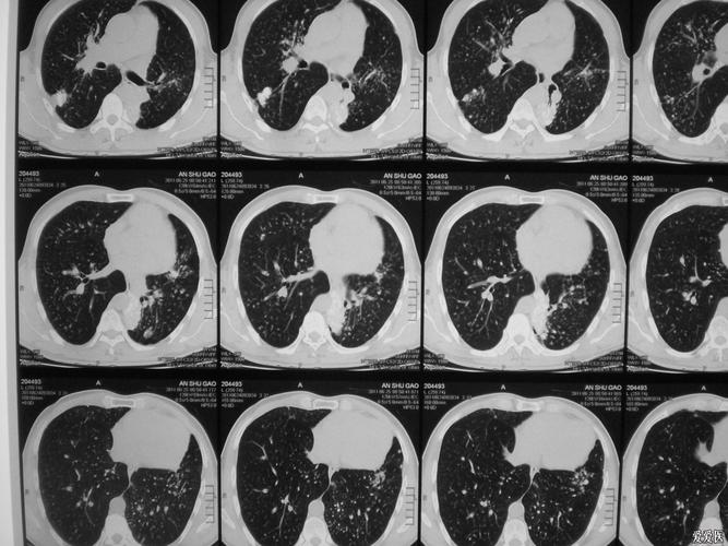 怀疑结核或者尘肺的大家给点意见