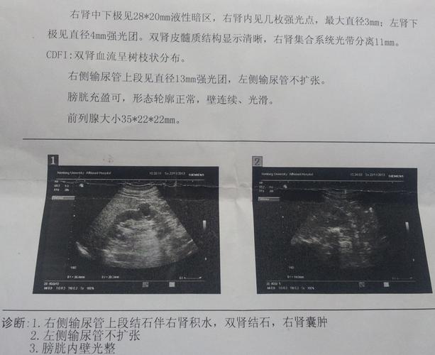 救命啊!我输尿管上段结石 大小13mm×4mm 请问怎么治疗 谢谢