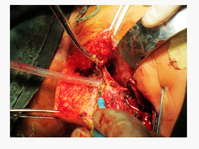 得了肛瘘如何诊治?(附示意图)