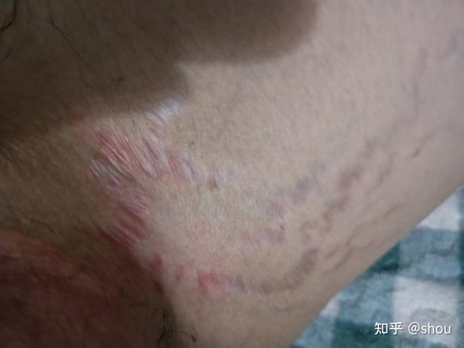 大腿内侧有条纹一年了请问这到底是股藓还是肥胖纹