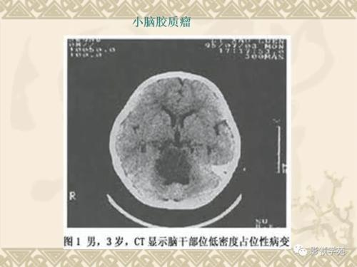 其强化原因为肿瘤新生血管及内皮细胞增生区,可反映血脑屏障破坏的