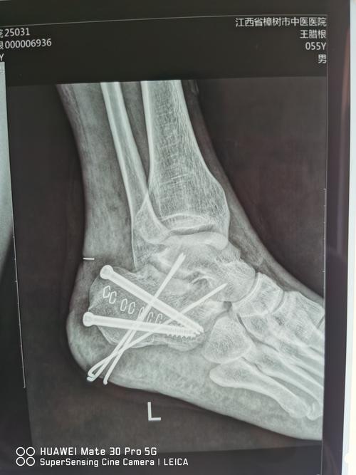 跗骨窦小切口入路治疗跟骨粉碎性骨折 病案一例