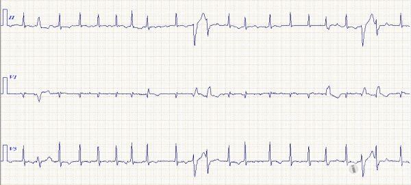 求助心电图 20130614