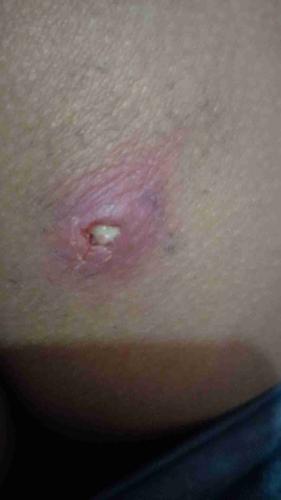 屁股处长了个疖肿,里面是不是有脓栓啊?怎么解决?