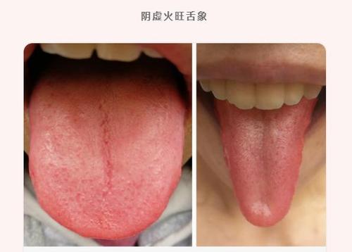 桑葚特别适合以下阴虚火旺舌象的女性,一般大众也适合保健食用.