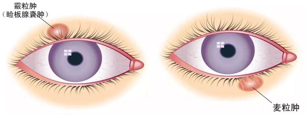 麦粒肿和霰粒肿怎么区分?