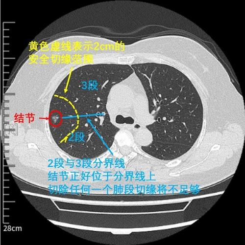 单孔胸腔镜右肺上叶 s2b s3a联合亚段切除术