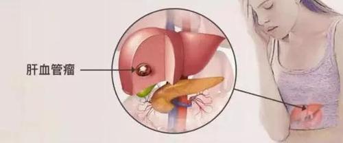 肝血管瘤,是一种没有临床症状的疾病,可由先天和后天因素引发