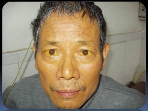 原创乙肝患者一旦发现3个部位很黄别久拖赶紧检查以免成癌