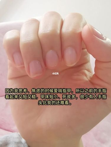 边缘参差不齐,甲床又短又宽,指甲又薄又脆,涂什么指甲油都不好看去年