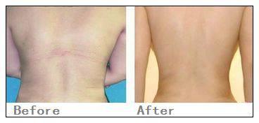 yestar背部吸脂术 重现你迷人背影