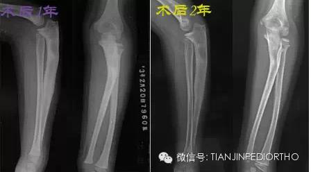 问倒老师系列之七儿童陈旧孟氏骨折二