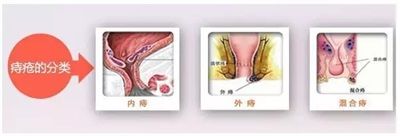 痔疮的治疗方法