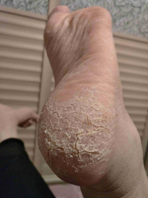 脚部干裂怎么回事,如何治疗