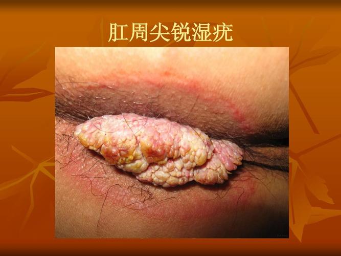 肛周尖锐湿疣