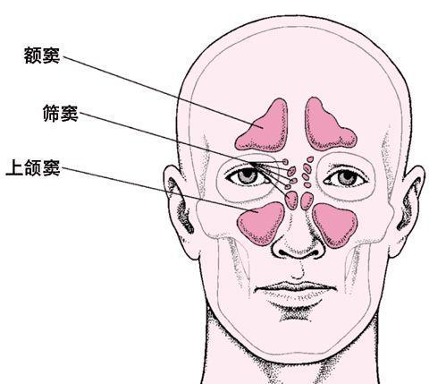 源自网络上颌窦炎可产生面颊部疼痛,牙痛和头痛;额窦炎有前额部疼痛